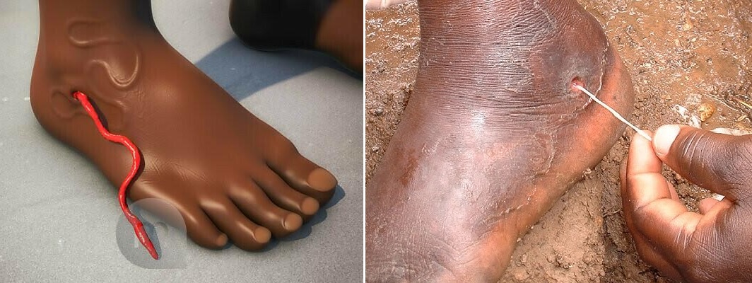 What is Guinea Worm Disease (Dracunculus Medinensis ) ?